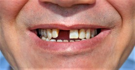 Un medic spune de ce oamenii își pierd dinții